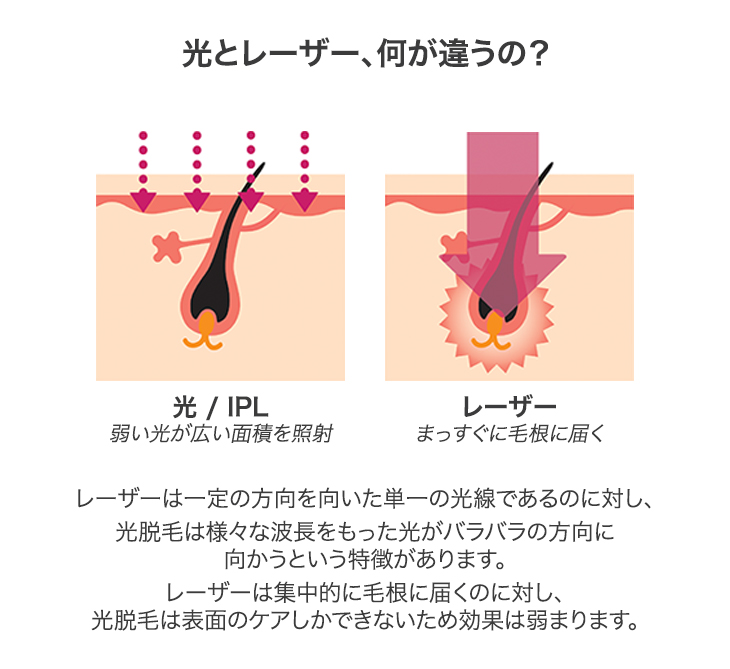 トリア　レビュー　レーザー脱毛と光脱毛の違い